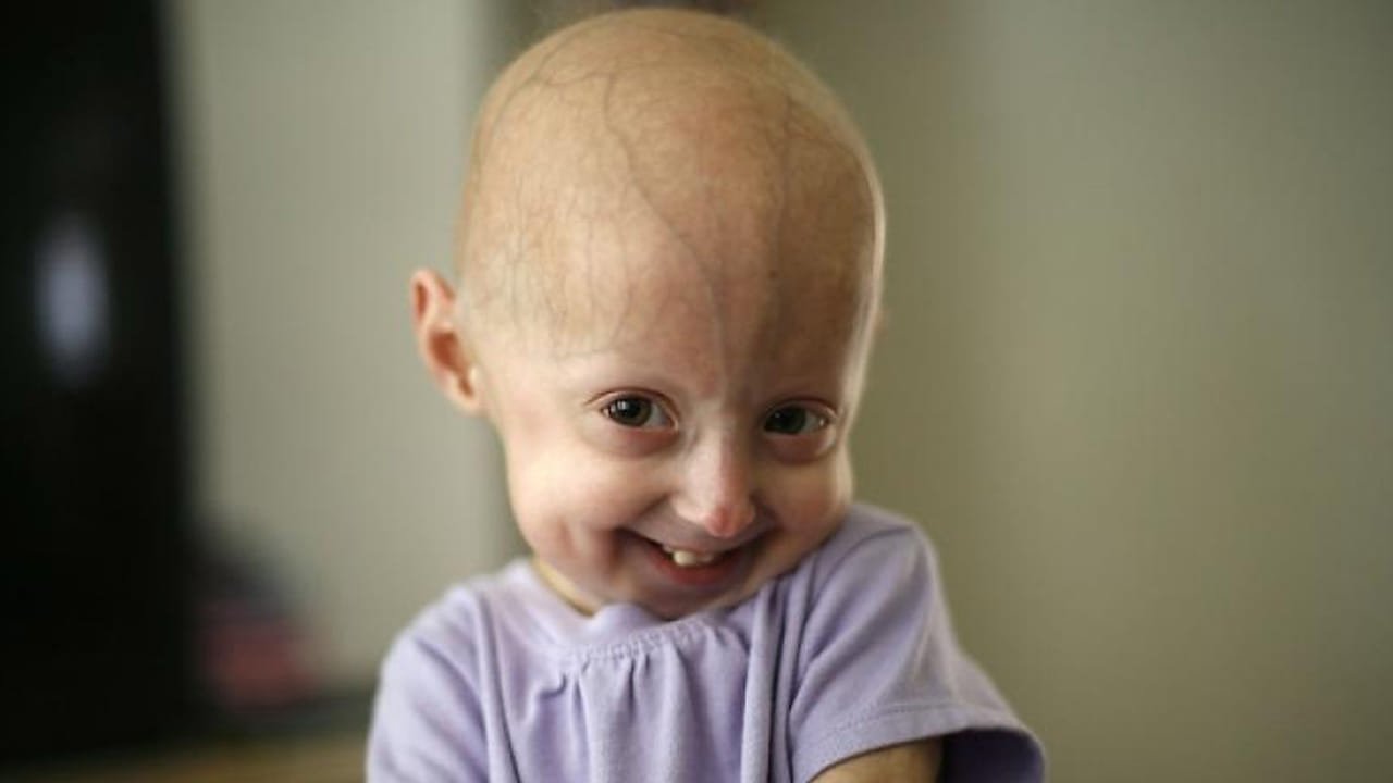 చిన్నారుల ప్రాణాలు తీస్తున్న అరుదైన జన్యు వ్యాధులు: మేనరికం వల్ల ముప్పు తలెత్తుతోందా?